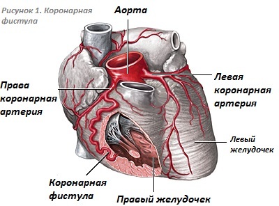 Коронарно-легочная фистула у ребенка, взрослого. Что это такое, причины, последствия, лечение