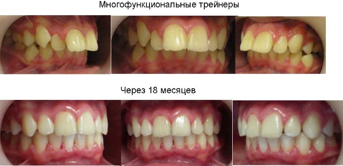 Кривые зубы у ребенка фото