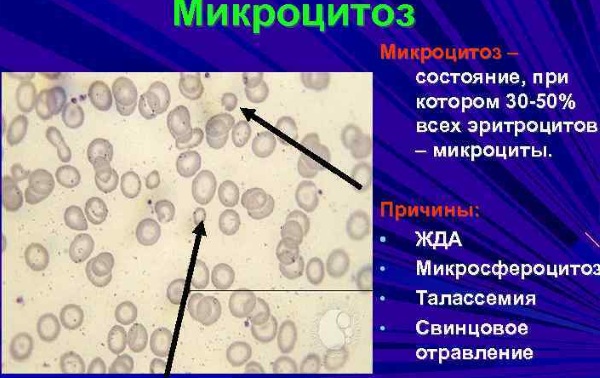 Микроцитоз в общем анализе крови у женщин, ребенка, взрослых. Что это, причины, как лечить