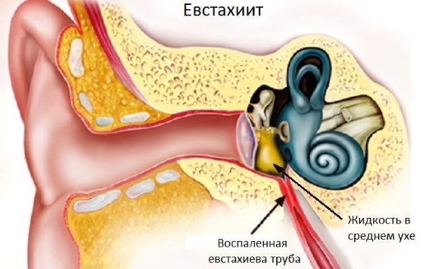 Туя в гомеопатии. Показания к применению, отзывы