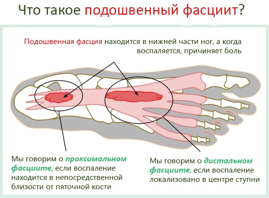 Плантарный фасциит. Симптомы и лечение народными средствами, медикаментами, массажем, гимнастикой