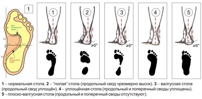 Плоскостопие. Симптомы у взрослых, степени, как определить, лечение