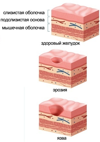 Гастрит у женщин. Симптомы и лечение, диета, народные средства, препараты