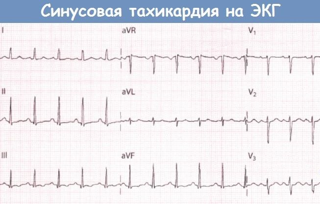 Пульс 180-190-200-210-220 ударов в минуту в состоянии покоя, при беге, нагрузке. Что это значит, причины, лечение взрослого, ребенка