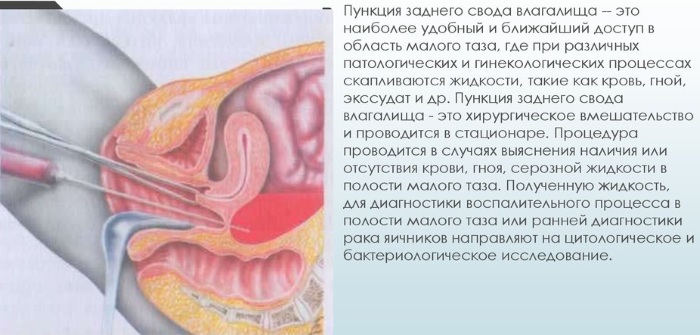 Пункция заднего свода в гинекологии. Что это такое, алгоритм, инструменты, показания