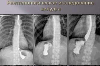 Рентгенологическое исследование желудка фото