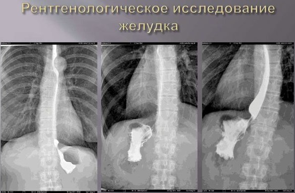 Рентгеноскопия желудка. Что это такое, подготовка к исследованию, как делается, что показывает