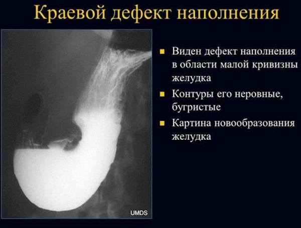 Рентгеноскопия желудка. Что это такое, подготовка к исследованию, как делается, что показывает