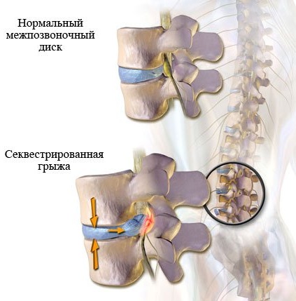 Секвестрация грыжи межпозвоночного диска. Что это такое, симптомы, лечение