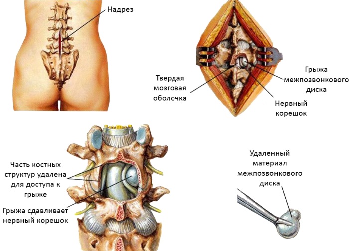 Секвестрация грыжи межпозвоночного диска. Что это такое, симптомы, лечение