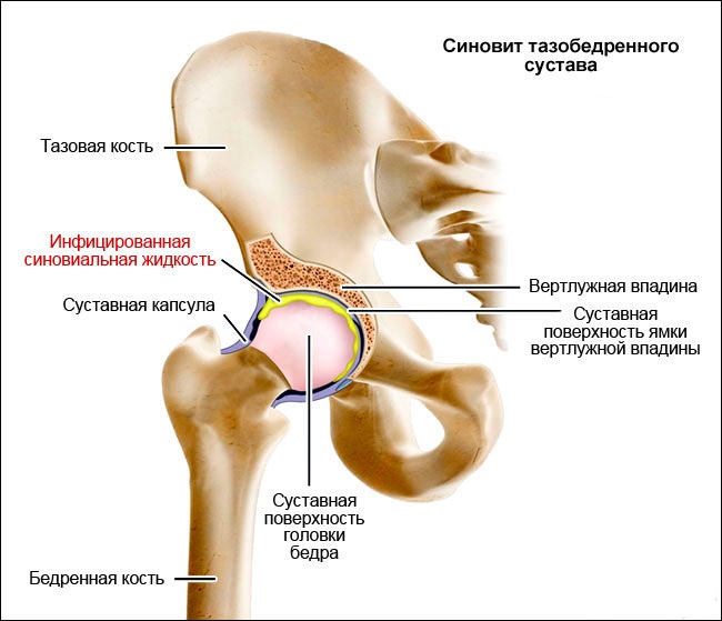 Синовит тазобедренного сустава. Симптомы, лечение, что это такое, причины