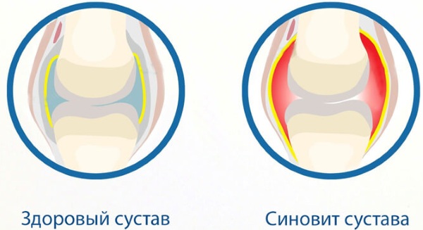 Синовит тазобедренного сустава. Симптомы, лечение, что это такое, причины