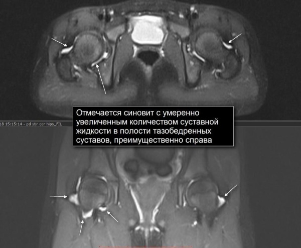 Синовит тазобедренного сустава. Симптомы, лечение, что это такое, причины