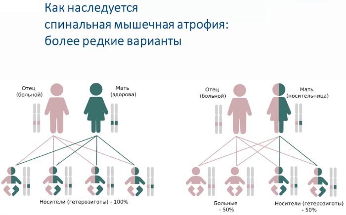 Спинальная мышечная атрофия картинки