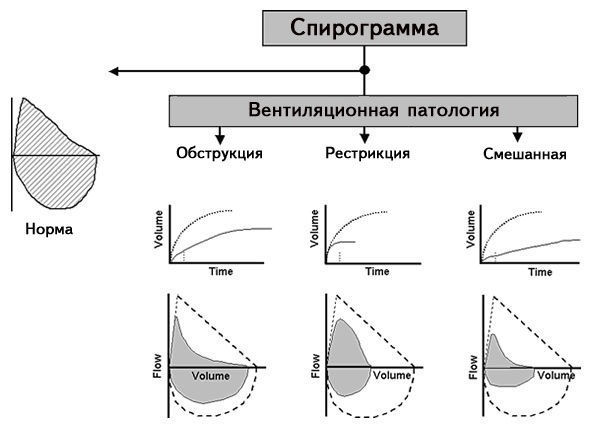 Спирометрия (спирография). Нормальные показатели, таблица, как проводится, расшифровка результатов