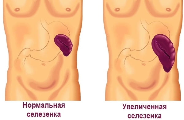 Спленомегалия. Что это такое, как лечить, причины умеренной, незначительной, портальной, выраженной, анализы