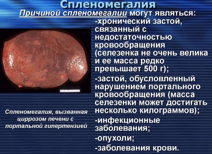 Спленомегалия. Что это такое, как лечить, причины умеренной, незначительной, портальной, выраженной, анализы