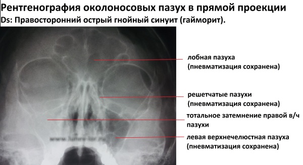 Хронический синусит. Симптомы и лечение у взрослых, детей, клинические рекомендации