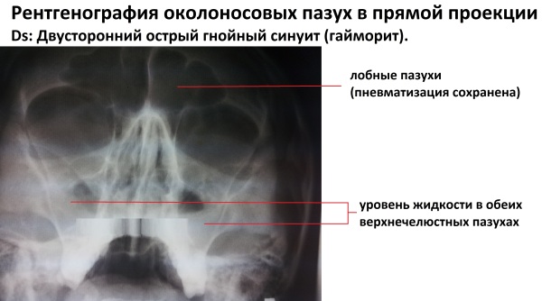 Субтотальное затемнение верхнечелюстных пазух что это такое. Смотреть фото Субтотальное затемнение верхнечелюстных пазух что это такое. Смотреть картинку Субтотальное затемнение верхнечелюстных пазух что это такое. Картинка про Субтотальное затемнение верхнечелюстных пазух что это такое. Фото Субтотальное затемнение верхнечелюстных пазух что это такое