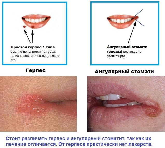 Лечение трещин в уголке рта, заед, если не заживает. Ангулит у детей, взрослых