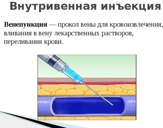 Внутривенные инъекции. Алгоритм выполнения на дому, места введения, осложнения