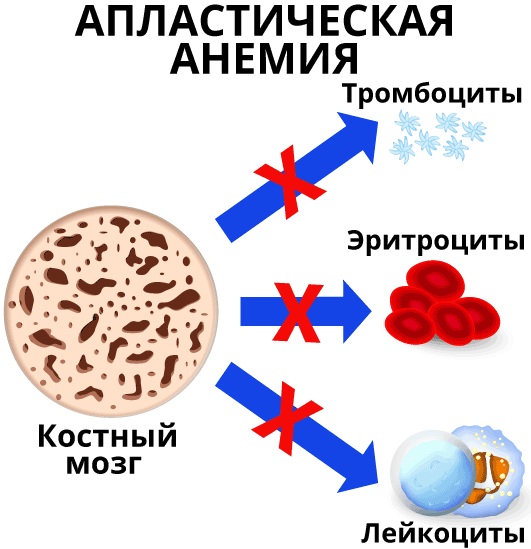 Анемия Даймонда-Блекфена (АДБ) у детей. Что это такое, патогенез, диагностика