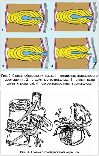 Дегенеративно-дистрофические изменения позвоночника. Что это такое шейного, грудного, поясничного отдела, симптомы, лечение