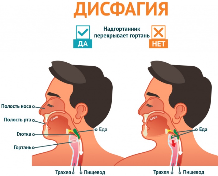 Дисфагия пищевода. Симптомы и лечение, что это такое, причины