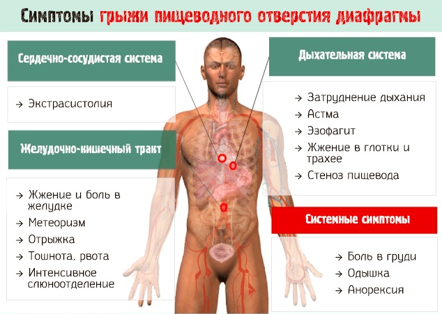 Дисфагия пищевода. Симптомы и лечение, что это такое, причины