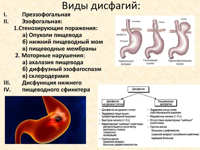 Дисфагия пищевода. Симптомы и лечение, что это такое, причины