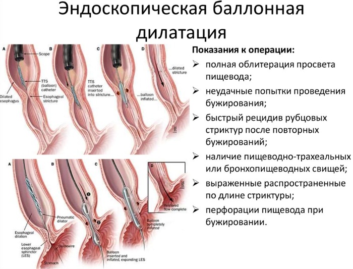 Дисфагия пищевода. Симптомы и лечение, что это такое, причины