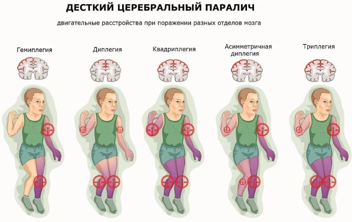 ДЦП (детский церебральный паралич). Причины у детей, что это такое, лечится или нет