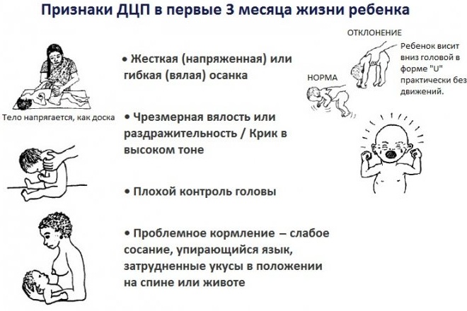 ДЦП (детский церебральный паралич). Причины у детей, что это такое, лечится или нет