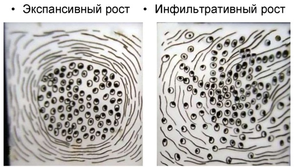 Экспансивный рост опухоли. Что это такое, для чего характерен, чем характеризуется, сопровождается