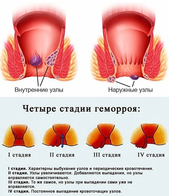 Заболевания прямой кишки. Классификация, симптомы, признаки