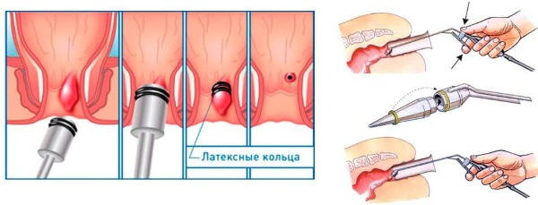 Геморройная шишка вылезла наружу. Какая мазь лучше помогает, чем лечить после родов, при беременности