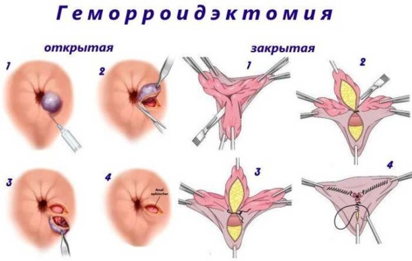 Геморройная шишка вылезла наружу. Какая мазь лучше помогает, чем лечить после родов, при беременности