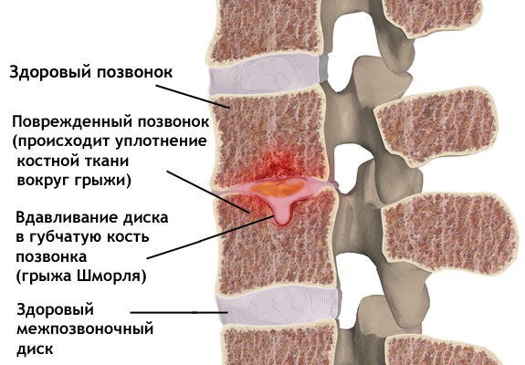 Карипазим при грыже позвоночника. Отзывы, цена