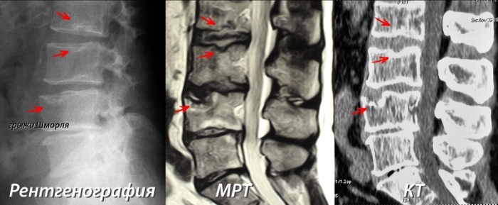 Грыжа Шморля на позвоночнике. Фото, что это такое, симптомы и лечение, опасность