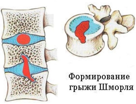 Грыжа Шморля на позвоночнике. Фото, что это такое, симптомы и лечение, опасность