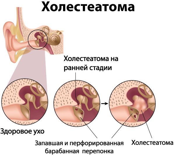 Кровь из уха. Причины у взрослого, ребенка после удара головой, чистки, при отите, без температуры, боли