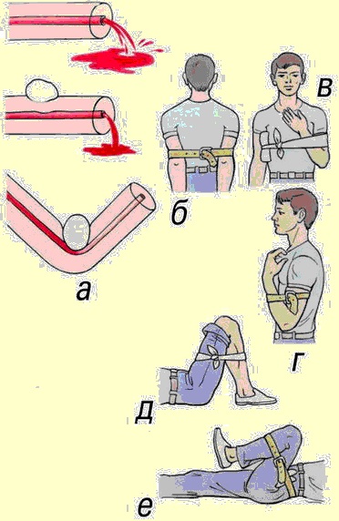 Кровотечение: понятие и виды, причины, первая помощь, способы остановки, лечение