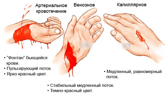 Кровотечение: понятие и виды, причины, первая помощь, способы остановки, лечение