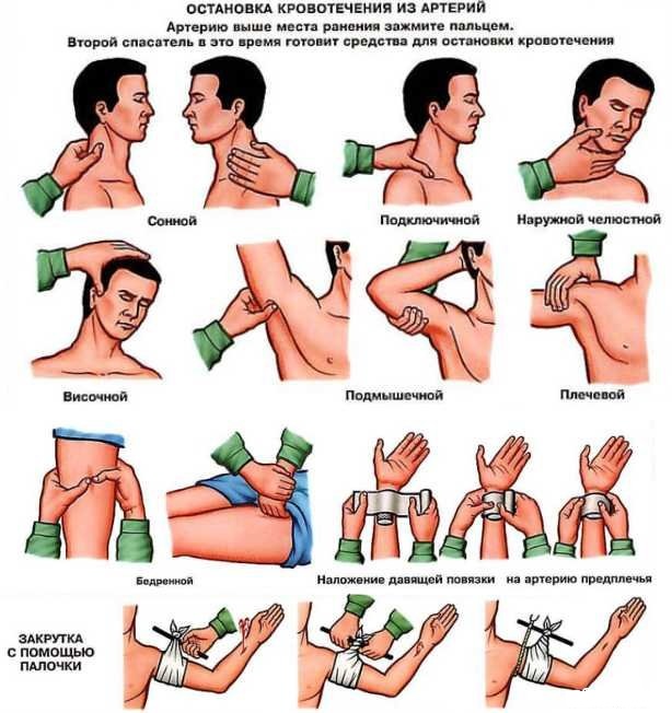 Кровотечение: понятие и виды, причины, первая помощь, способы остановки, лечение
