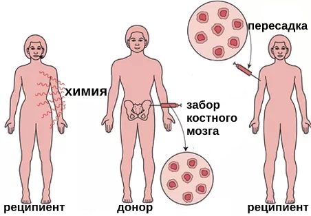 Лейкопения. Причины возникновения у взрослых, ребенка, симптомы, лечение