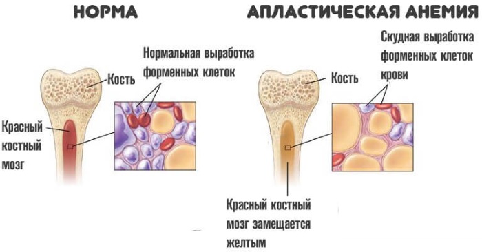 Лейкопения. Причины возникновения у взрослых, ребенка, симптомы, лечение