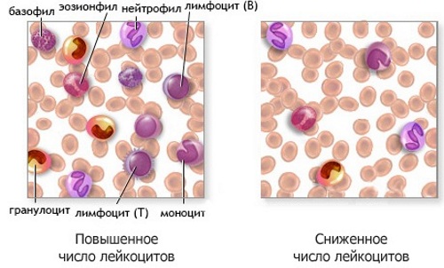 Лейкопения. Причины возникновения у взрослых, ребенка, симптомы, лечение