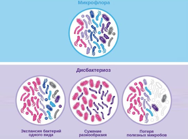 Нарушение микрофлоры у женщин в гинекологии. Причины, симптомы, лечение