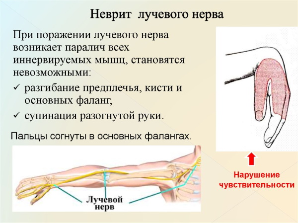 Немеют мизинцы на обеих руках. Причины, от чего во время сна, лечение