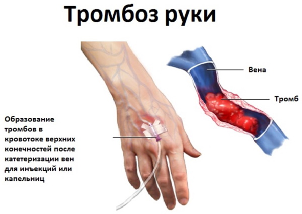 Немеют мизинцы на обеих руках. Причины, от чего во время сна, лечение